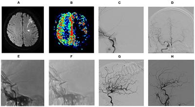 Drug-Coated Balloon for the Treatment of Nonacute Symptomatic Intracranial Carotid Artery Terminus Occlusion: Initial Experience and Follow-Up Outcome